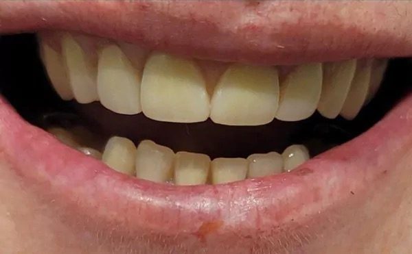 Restored, even smile after treatment at Providence Dental