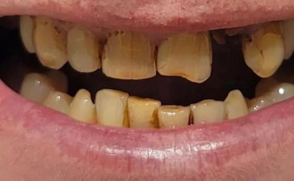 Discoloured, worn teeth before treatment at Providence Dental