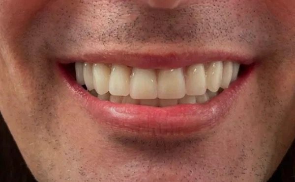 Brighter smile after whitening at Providence Dental
