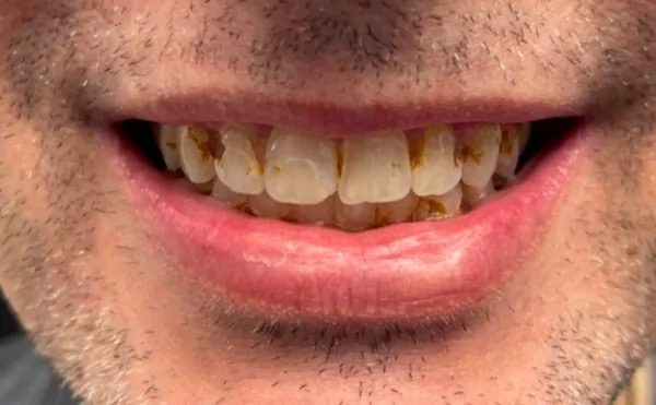 Stained teeth before whitening at Providence Dental