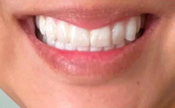 Natural-looking smile after restorative treatment