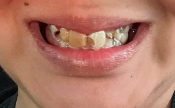Damaged front teeth before restorative treatment