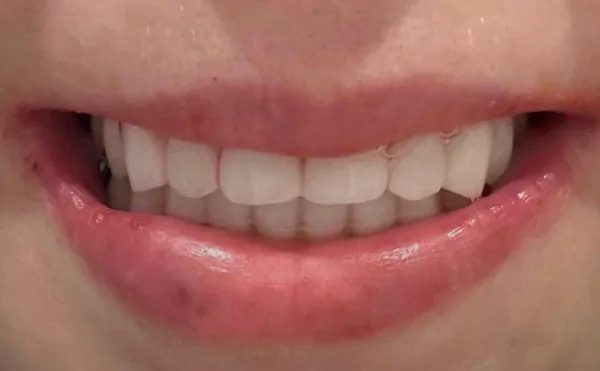 Complete smile makeover result at Providence Dental
