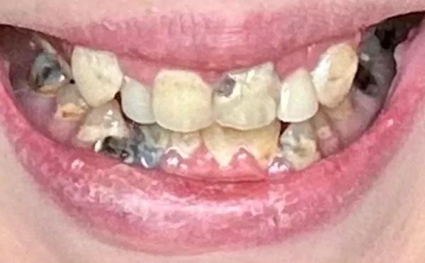 Decayed teeth before full smile restoration