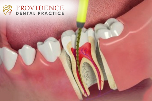 Endodontic treatment process showing root canal cleaning to remove infection and save a natural tooth at Providence Dental Practice.